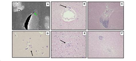 Ex Vivo Mri And Autopsy Neuropathology In Case A Ex Vivo Coronal