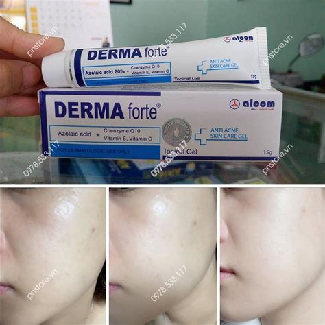 Kem Trị Mụn Mờ Thâm Sẹo Derma Forte Chính Hãng 15g