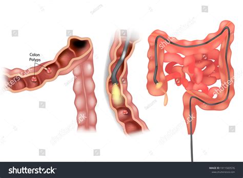 Removal Polyps Colon Colonoscopy Stock Vector (Royalty Free) 1911583576 ...