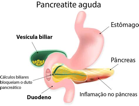 Cirurgia De Pedra Na Ves Cula Dr Christiano Claus