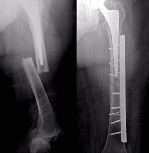 Rehabilitación y tratamiento de una fractura de fémur en Barcelona