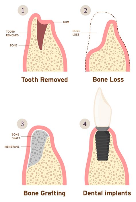 Dental Bone Grafting in Everett, WA | Young Dental Care