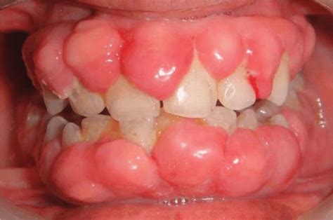 Generalized Enlargement Of Marginal Gingiva Attached Gingiva And