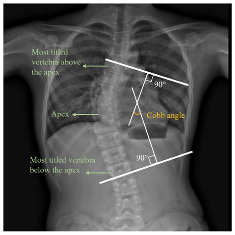 Electromyographic Analysis Of Paraspinal Muscles Of Scoliosis Patients