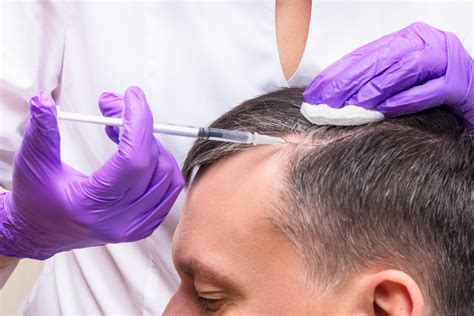 The Comprehensive Guide To Microneedling For Hair Restoration