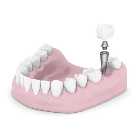Osseointegration Dental Implants Costa Mesa, CA - Newport Dental Group