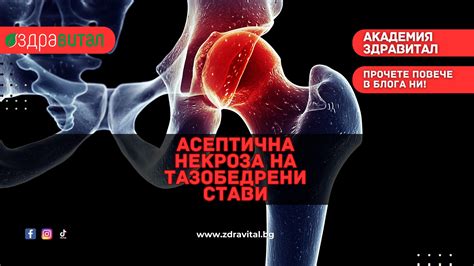 Асептична Некроза на Тазобедрени Стави