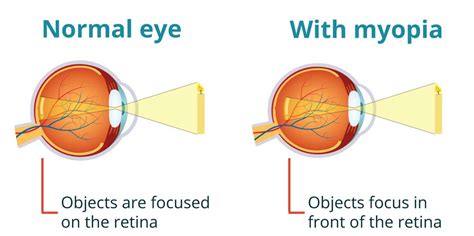myopia management innovision family eye care tx