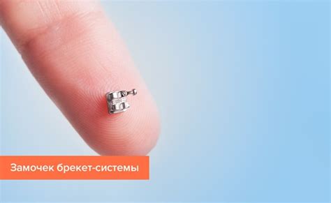 Брекеты: разновидности, особенности конструкций, цены на установку брекетов