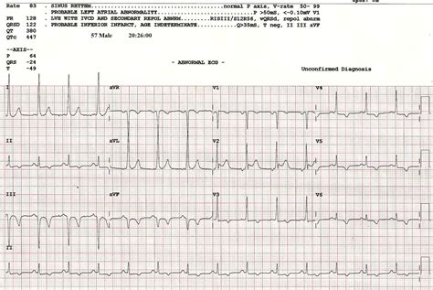 Wpw After Cardioversion From Wide Complex Tachycardia Ecg Guru