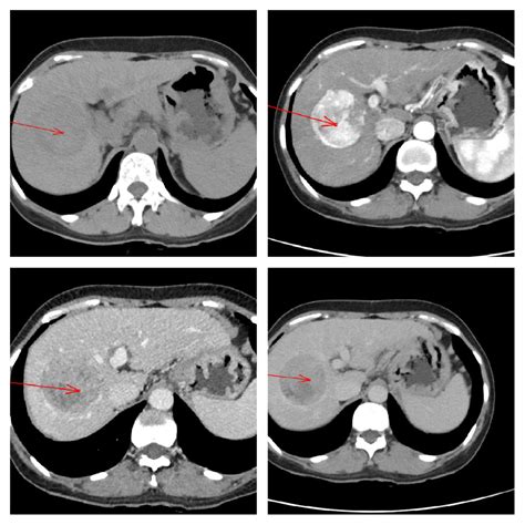 肝癌，胰腺癌，转移瘤一文理清肝胆胰常见疾病的 Ct 鉴别诊断肝癌ct胰腺癌新浪新闻