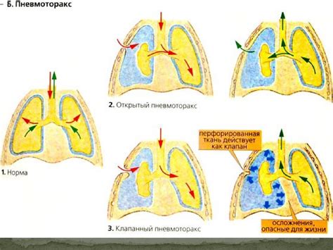 Домедична допомога в екстремальних умовах. Травми грудної клітки ...