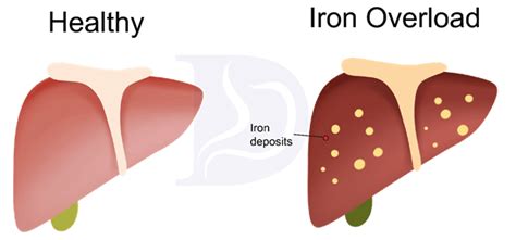 Hemochromatosis - Digestive and Liver Health Specialists