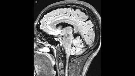 Corpus Callosum Lesions - The Neurology Hub