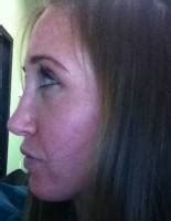 pixie nose rhinoplasty cost pics reviews qa