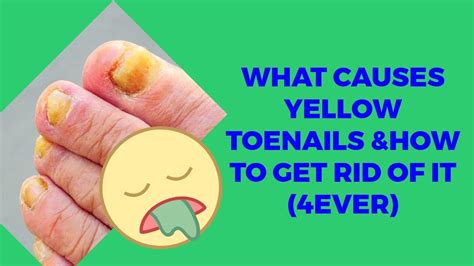 What Causes Yellow Toenails Get Rid Of Yellow Toenails Youtube