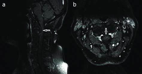 Postcontrast Fat Saturated T1 Weighted MRI Showing A Hypointense Signal