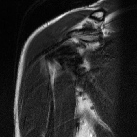 Hill Sachs And Osseous Bankart Lesions Image Radiopaedia Org