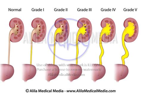 Alila Medical Media Grados De Reflujo Vesicoureteral Nefropat A Por