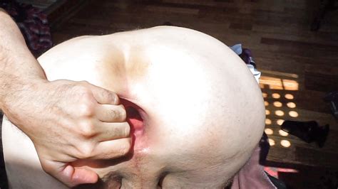 Anal Fistfuck And Gaping Asshole Pics Xhamster