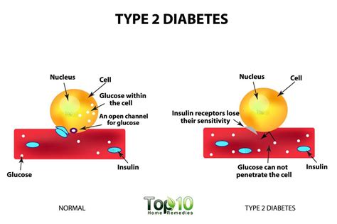 Type 2 Diabetes Risk Factors: Are you at Risk? | Top 10 Home Remedies