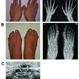 Skeletal Anomalies In Patient 1 A Picture And Radiograph Of The