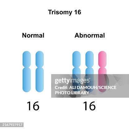 trisomy  syndrome illustration high res vector graphic getty images