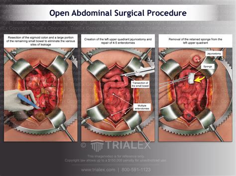 Open Stomach Surgery