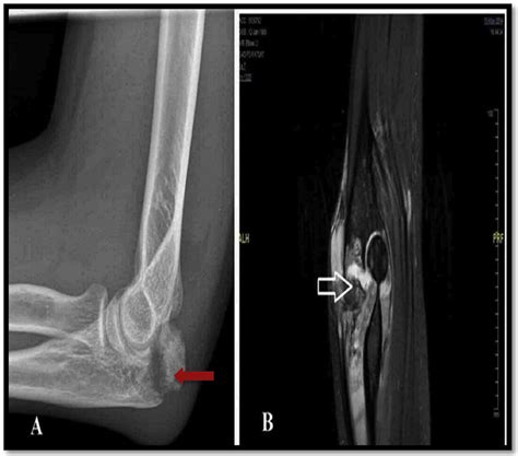 A Plain X Ray Of The Left Elbow Showed Cranial Displacement Of A