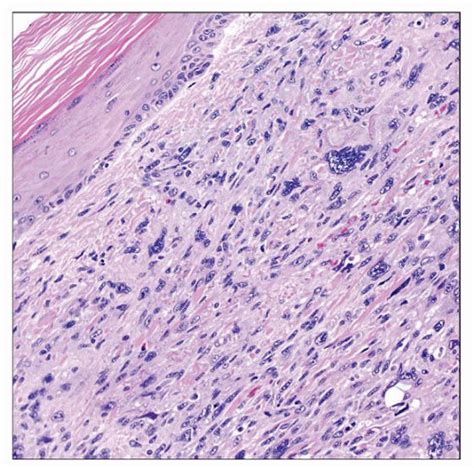 Cutaneous Malignant Fibrous Histiocytomapleomorphic Sarcoma