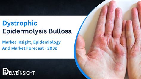 Dystrophic Epidermolysis Bullosa Market Size Was More Than Usd