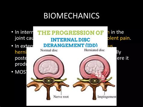 Prolpased Inter Vertebral Disc Pivd PPT