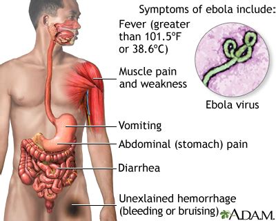 Ebola virus disease - UF Health