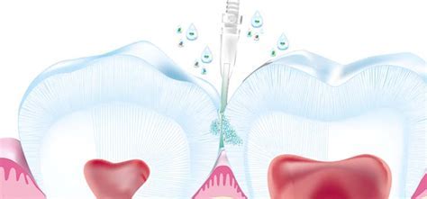 Curodont Repair Une Technologie Suisse La D Fense Dentiste