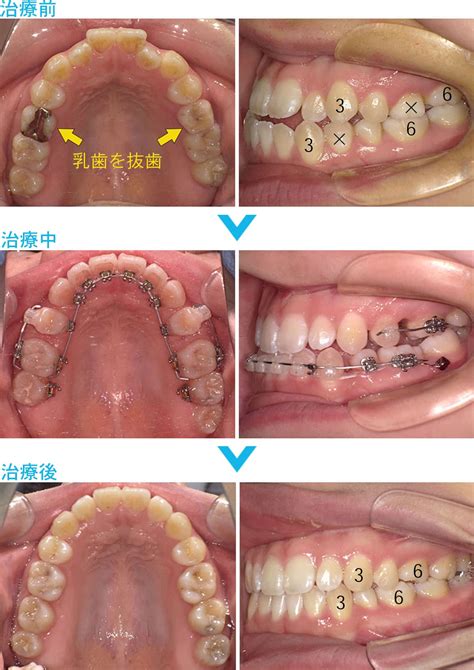 永久歯が足りない 乳歯が残っている 横浜市港北区【joy矯正歯科クリニック】