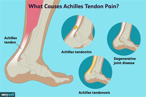 Heel Pain | ReLiva Physiotherapy & Rehab