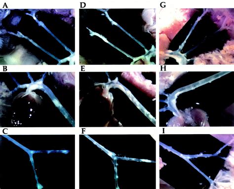 Accelerated Atherosclerosis And Premature Calcified Cartilaginous