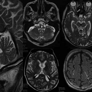 (PDF) CT and MRI of Wernicke's encephalopathy