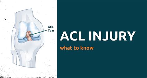 ACL Injury – What to Know