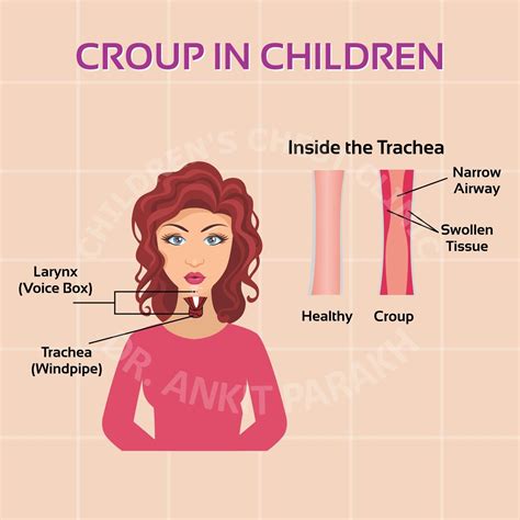 Croup in Children – Symptoms, Diagnosis and Treatment – Dr. Ankit