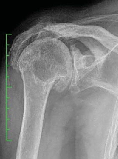Cuff Tear Arthropathy Download Scientific Diagram