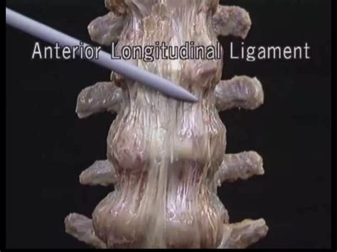 Prolpased Inter Vertebral Disc Pivd PPT