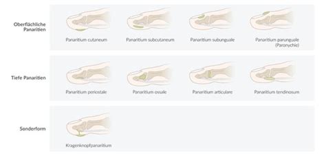 7. Inflammatory diseases of the fingers and hand - panaritium (clinical ...