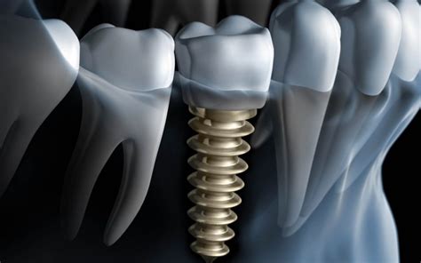 C Mo Es El Proceso De Colocaci N De Un Implante Dental Paso A Paso