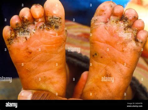 Chigoe Fleas In The Feet Of A Three Year Old Peruvian Girl The Chigoe