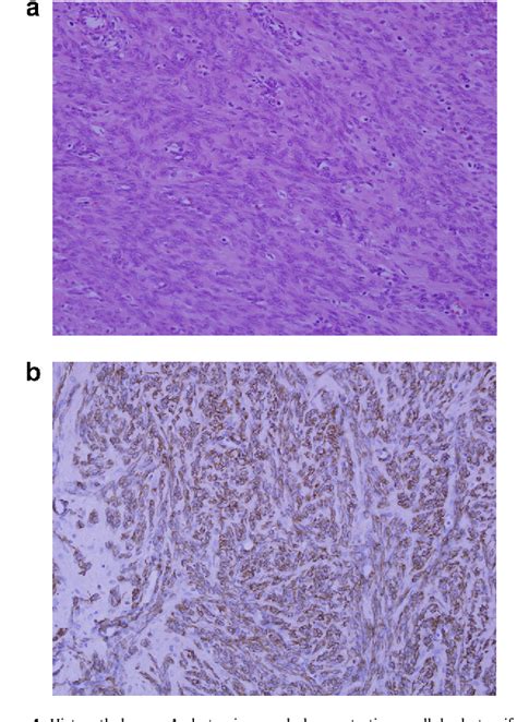 Intravenous Leiomyomatosis With Intracardiac Extension A Review Of