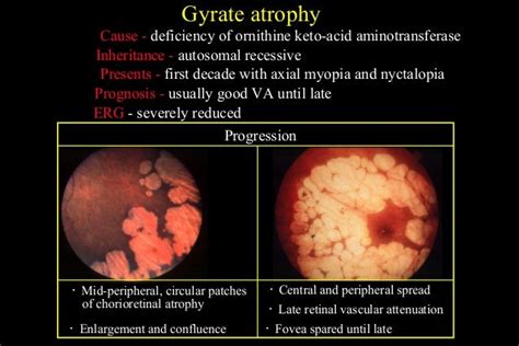 Pathology of uvea