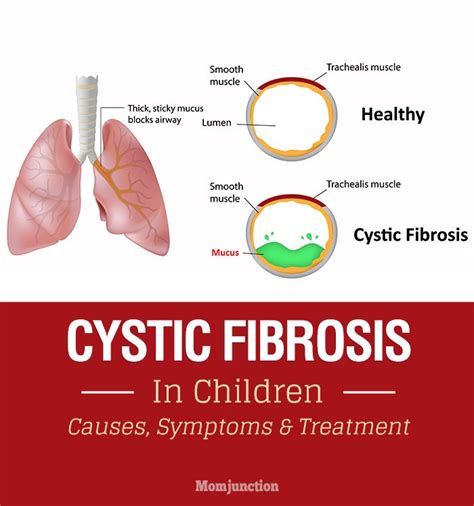 what causes cystic fibrosis - DriverLayer Search Engine