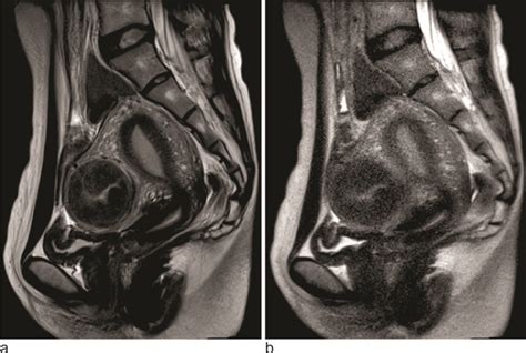 Mri Female Pelvis Anatomy