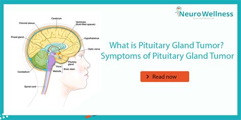 What is Pituitary Gland Tumor? Symptoms of Pituitary Gland Tumor